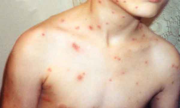 Murió un chico por varicela: Advierten sobre "un brote" en el país