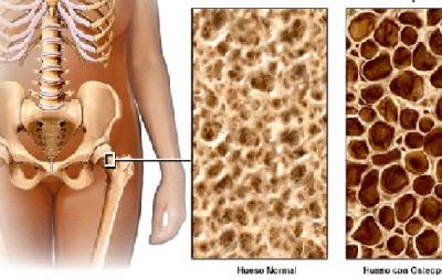 Osteoporosis: El colesterol agrava el debilitamiento de los huesos